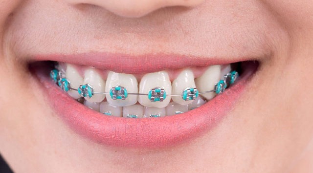 Como funciona o alinhador dental transparente? Ele é melhor que o de metal?  - 27/06/2019 - UOL VivaBem
